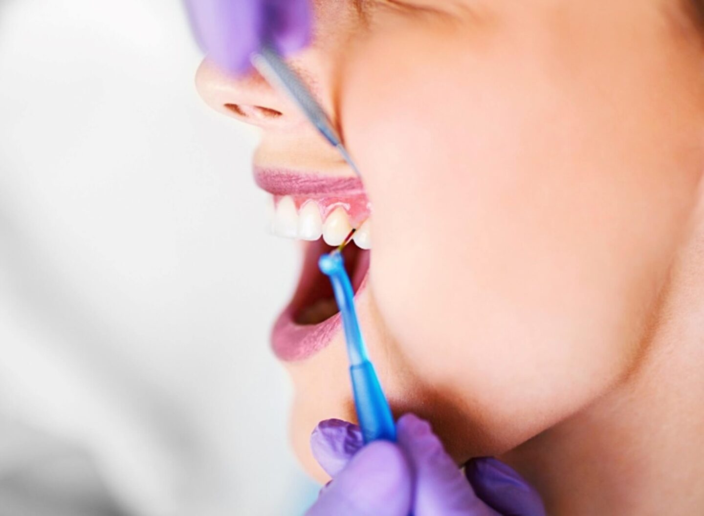 A female patient is undergoing a gingivitis treatment in Beverly Hills, CA