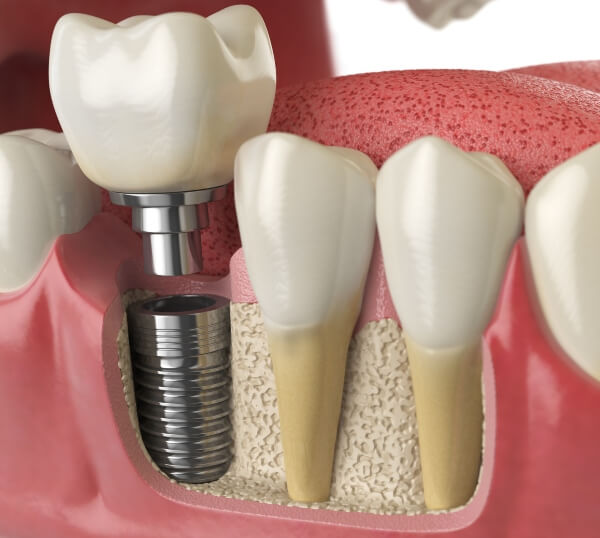3D image of Dental tooth Implant