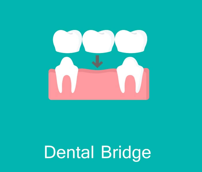 Dental bridge services in Beverly Hills, CA