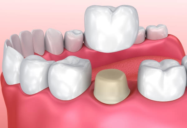 Dental crown fitting in Beverly Hills, CA