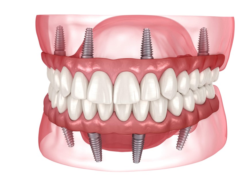 A close-up of a human jaw showing All-On-4 implant locations