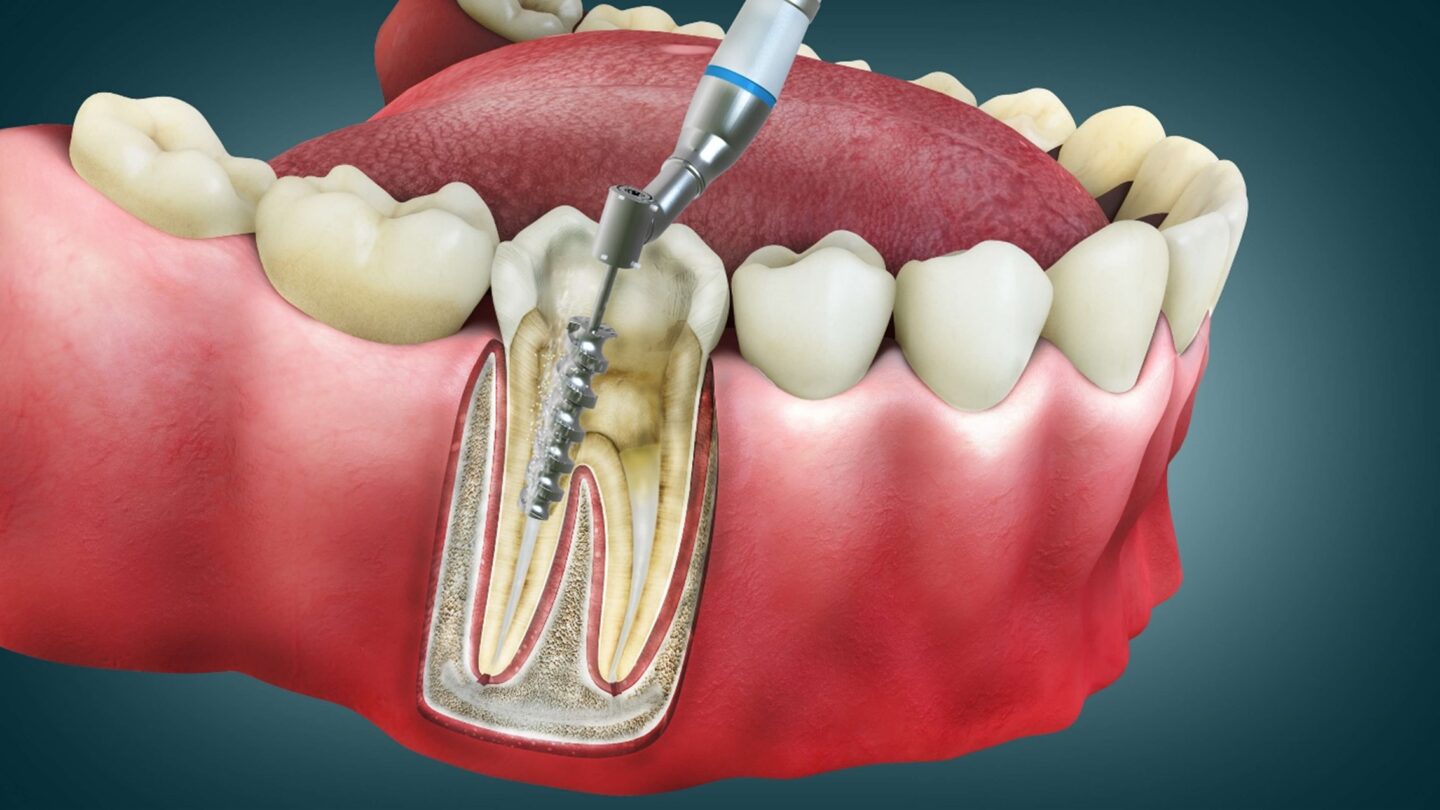 Medical illustration showing internal tooth structure during a root canal procedure in Beverly Hills