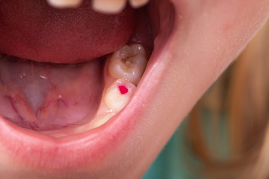 Close up on abscessed tooth