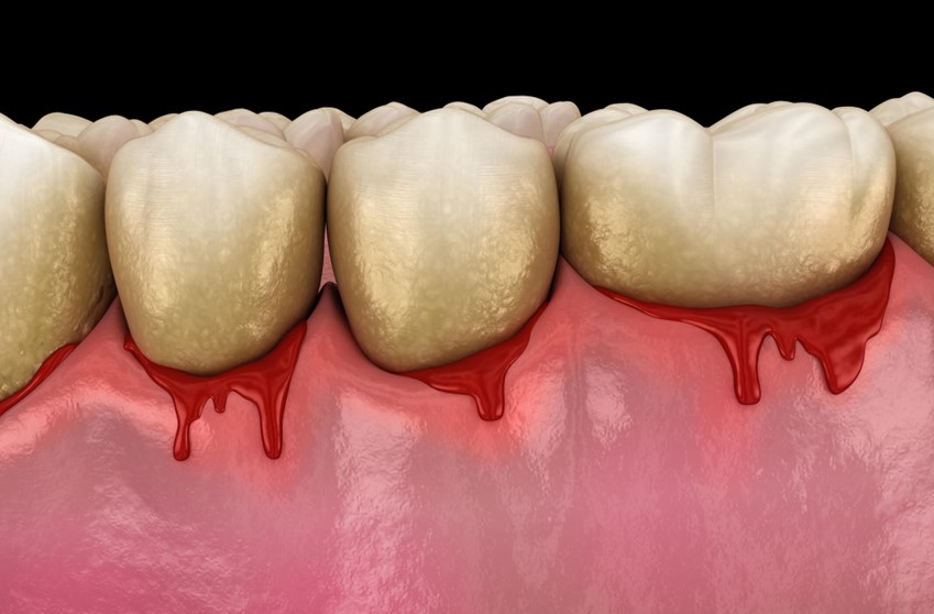 Bleeding gums