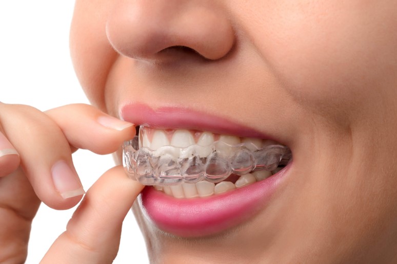 Invisalign being placed on teeth